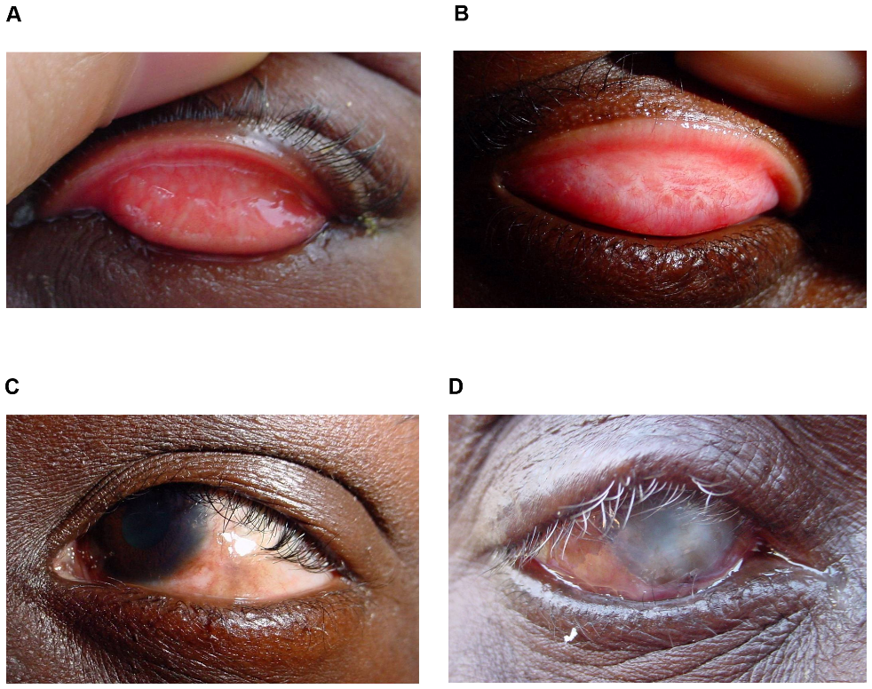 Signs and Symptoms of Trachoma